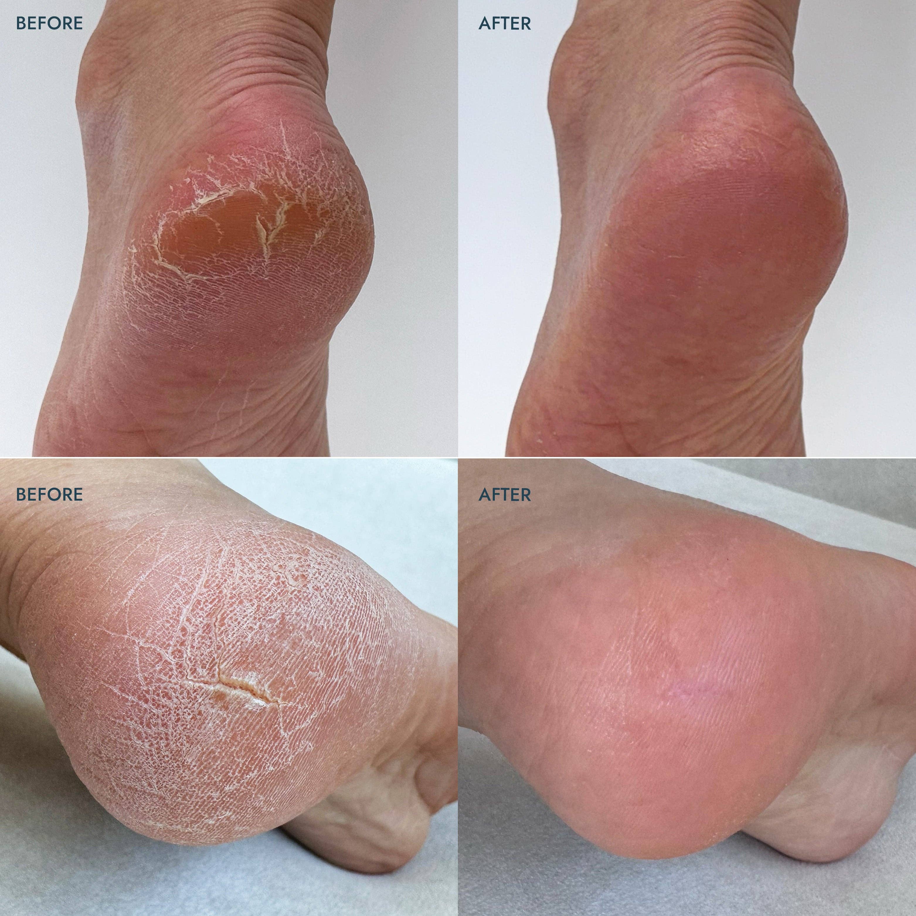 Heel Repair Duo - Lavender